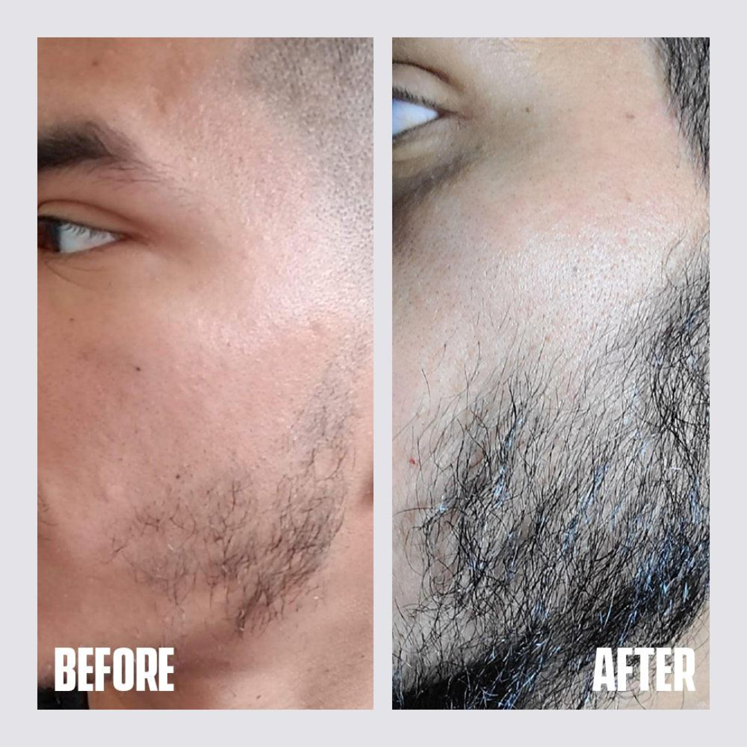 Dr. Alies Professional Beard Growth Oil | Natural Formula with Vitamin E, Almond Oil & Castor Oil | Fills Patchy Areas, Reduces Itch & Strengthens Beard