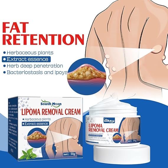 South Moon Lipoma Removal Cream || SUMMER SALE OFFER