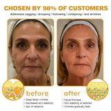 👨‍⚕️Botox Bee Venom Wrinkle Removal Cream