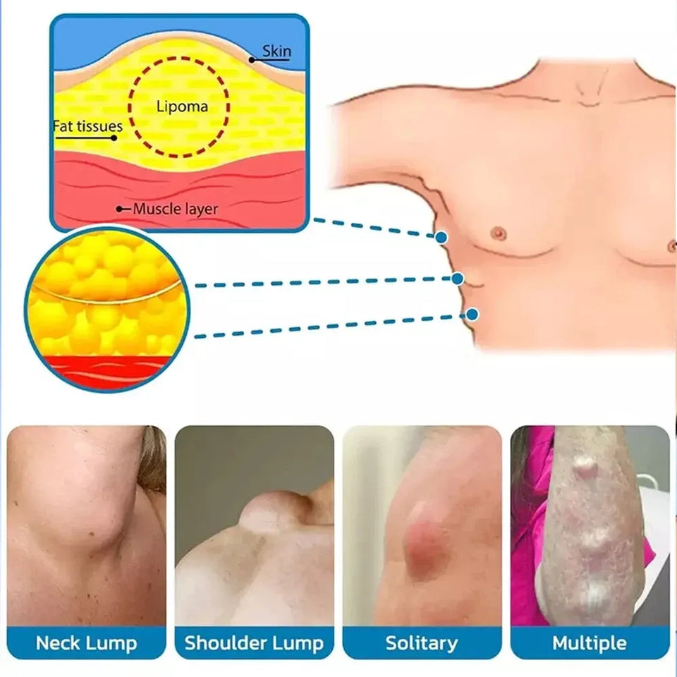 LIPOMA REMOVAL SPRAY (IMPORTED)